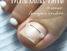 Лечение вросших ногтей без боли и операции